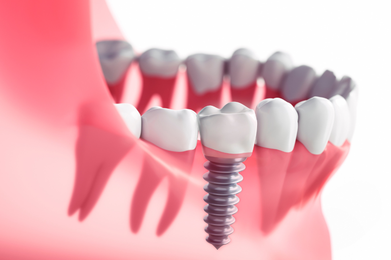 השתלות שיניים ביום אחד - מהפכה בפה תוך מספר שעות